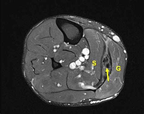 MRI axial section of the right calf showing the location of the ...