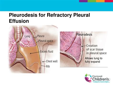 PPT Improved Instrumentation For Effective Mechanical Pleurodesis