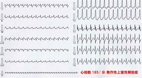 発作性上室性頻拍症｜パズルで分かる不整脈 みやけ内科・循環器科