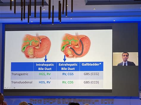 Keith Siau On Twitter EUS Guided Biliary Drainage Techniques