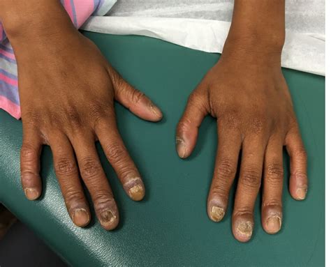 Nail Dystrophy And Nail Plate Thinning MDedge Pediatrics