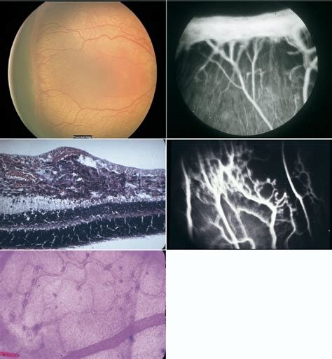 Zone 2 Retinopathy Of Prematurity ROP These Images Show The Classic