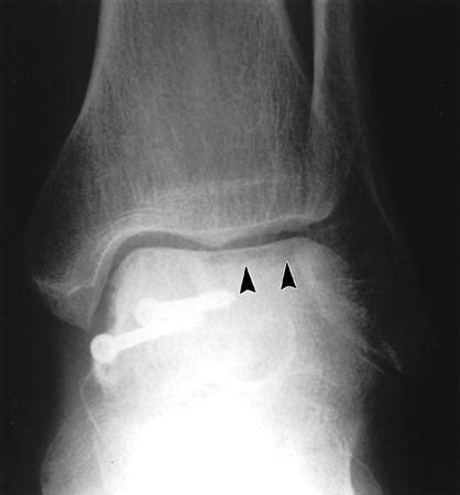 Talar Neck Fractures Trauma Orthobullets The Best Porn Website