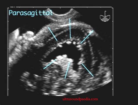 Intraventricular Hemorrhage Ultrasoundpaedia