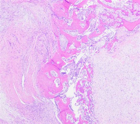 Sclerosing Epithelioid Fibrosarcomalow Grade Fibromyxoid Sarcoma Download Scientific Diagram