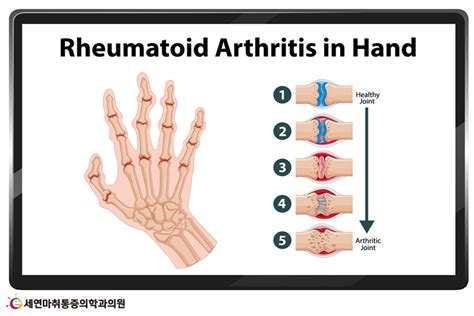 손가락이 뻣뻣하고 마디가 아프다 류마티스관절염 증상