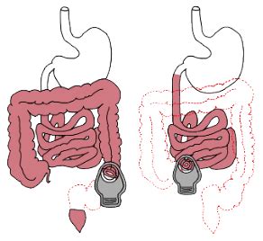 services treatments colorectal surgery