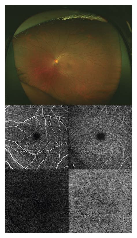 Representative images of no apparent diabetic retinopathy (a), mild ...