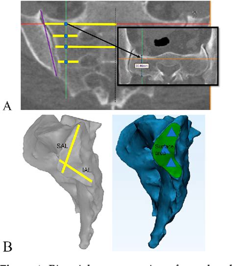 Figure From Ethnic Differences In Western And Asian Sacroiliac Joint