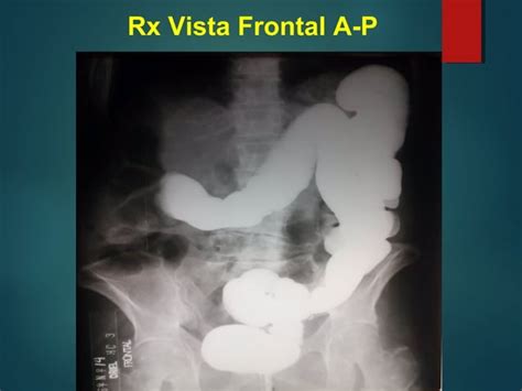 Tumor En Rx De Colon X Enema Diagn Stico Imagenol Gico Cl Nico