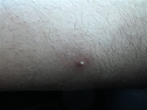 Was mowing the grass and got bitten by several fire ants. Now I have