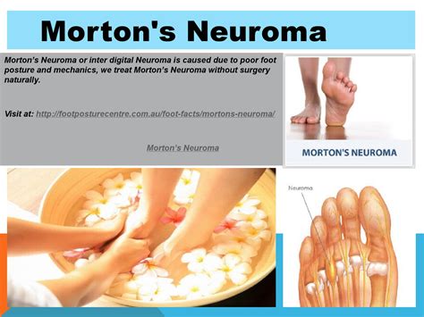 Morton's neuroma by Foot Posture Centre - Issuu