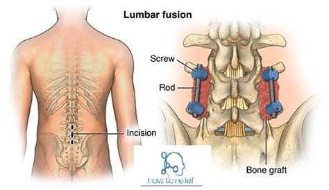 Spinal Stenosis: Symptom, Causes, Treatment & Exercises » How To Relief