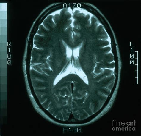 Female Normal Mri Brain