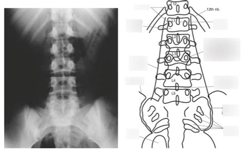 Anteroposterior Lumbar Spine Projection Diagram Quizlet