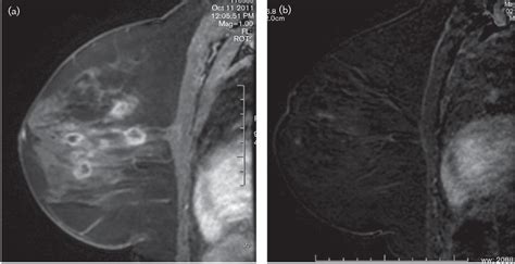 Figure From Rhodococcus Equi Granulomatous Mastitis In An