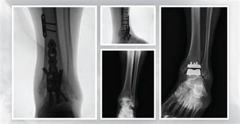 ANKLE ARTHRITIS TREATMENT – Di Nallo Orthopaedics