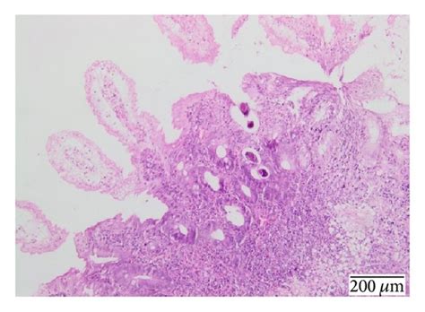 Duodenal Biopsy Showing Preserved Villi With Dystrophic Glands