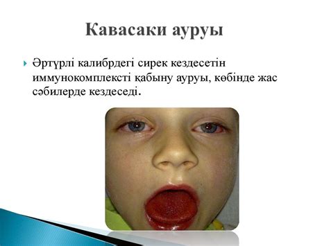 Кавасаки ауруы - презентация онлайн
