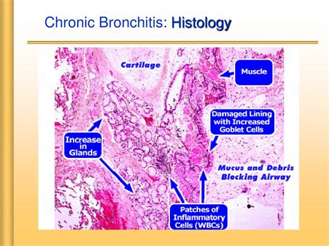 Chronic Bronchitis Histology