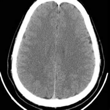 Computed Tomography Image Of The Brain Showing Mild Diffuse Cerebral