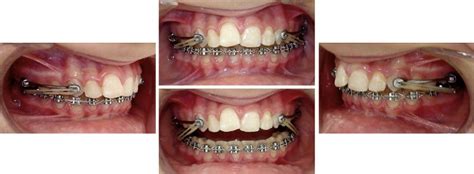 Treatment effects of the Carrière distalizer using lingual arch and