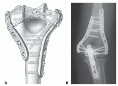 Open Reduction And Internal Fixation Of Supracondylar And Intercondylar Fractures