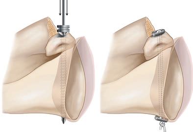 Early Followup Of Arthroscopic Latarjet Procedure With Screw Or Suture