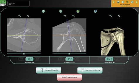 A Modification To The Walch Classification Of The Glenoid In Primary Glenohumeral Osteoarthritis