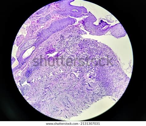 Skin Biopsy Pathology Basal Cell Carcinoma Stock Photo 2131307031 ... 