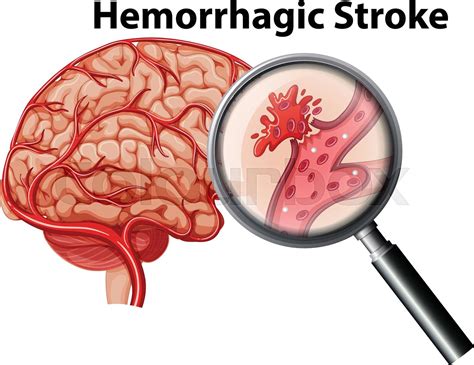 A human anatomy hemorrhagic stroke | Stock vector | Colourbox