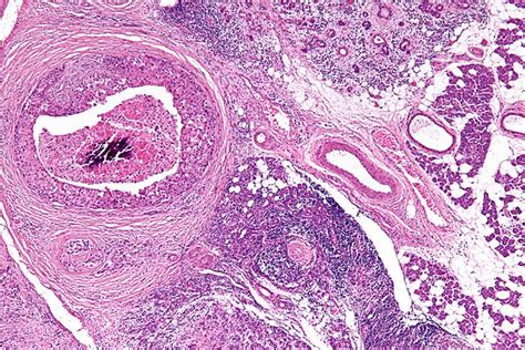 Salivary Duct Carcinoma Libre Pathology