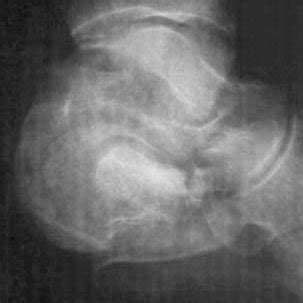 -CT-scan of an open calcaneal fracture with medial skin perforation ...