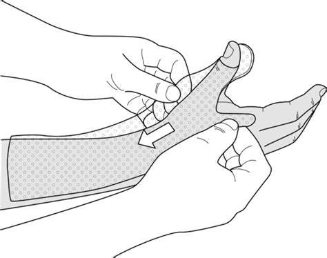 Guide Thumb extensor tendon splint