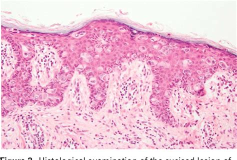 Figure 2 From A Rare Case Of Quadruple Extramammary Paget S Disease Including An Umbilical