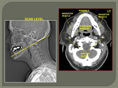 Ppt Ct Neck Powerpoint Presentation Free Download Id2036160