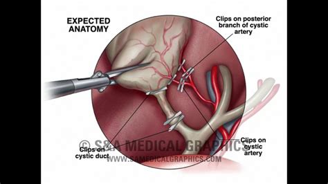 Laparoscopic Cholecystectomy Anatomy