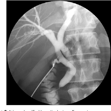 Figure From The Variation Of Hepatic Duct Confluence And