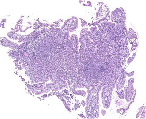 Duodenal Type Follicular Lymphoma Gastro Hep Advances