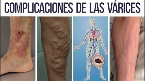 Consecuencias De Las V Rices Prevencion Y Tratamiento Dr Ivan