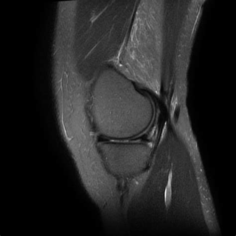 Excessive Lateral Pressure Syndrome Image Radiopaedia Org