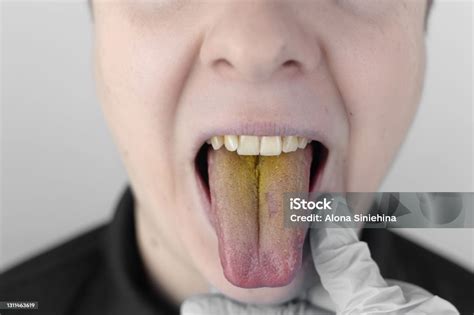 Lingua Amarela No Fundo - Foto de O Homem Tem Uma Língua Amarela Revestimento Amarelo Doloroso Na ...