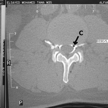 Axial MRI images showing postero-lateral L5-S1 disc protrusion which... | Download High-Quality ...