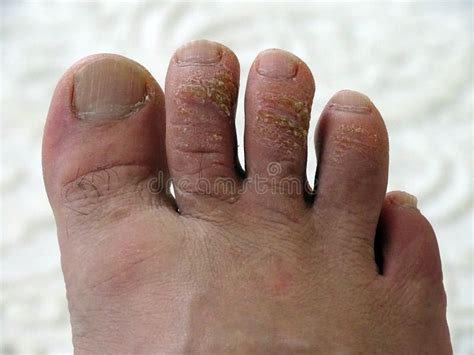 Why Are My Feet Itchy Our Top Tips For Itchy Toes And Feet My Footdr