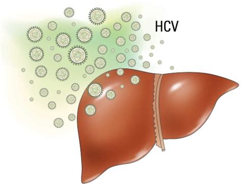 Hepatitis C Liver Disease