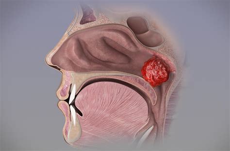 Adenoids And Tonsils