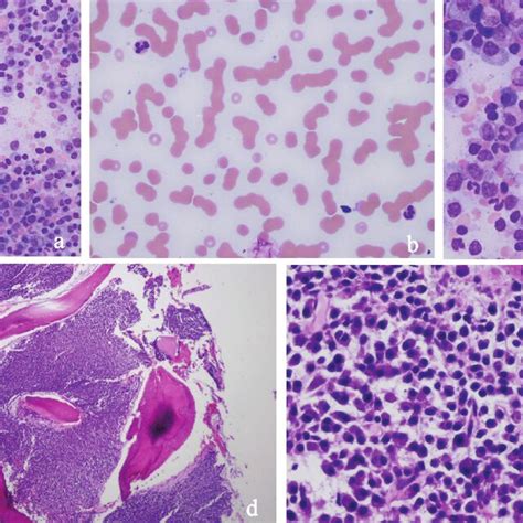 A Medium Power Field Of Bone Marrow Smear With Numerous Plasma Cells