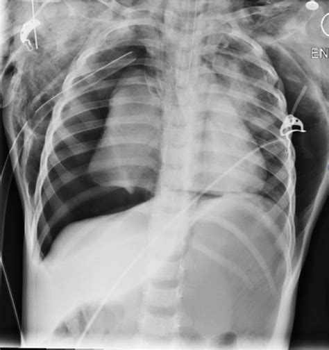 Case 1 Portable Anteroposterior Chest X Ray Demonstrating Large Right