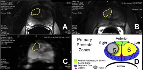 Figure 1 From Improving Detection Of Clinically Significant Prostate