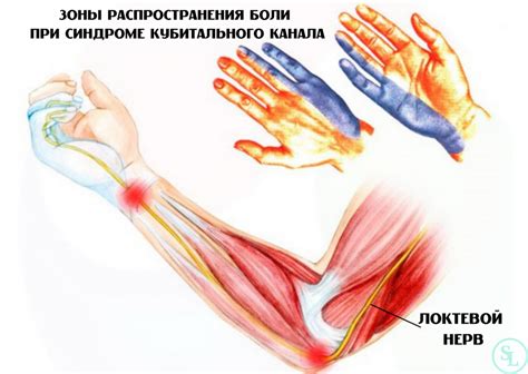 Синдром кубитального канала локтевого нерва: лечение, цена операции ...